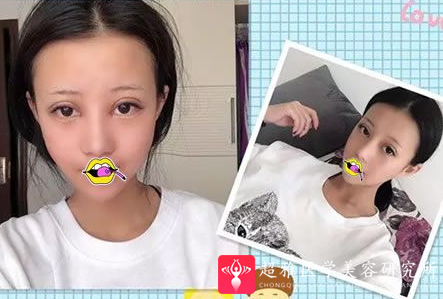双眼皮手术