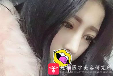 双眼皮手术
