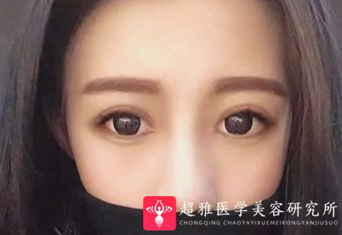 双眼皮手术