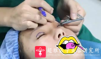双眼皮手术