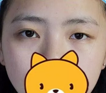 双眼皮手术