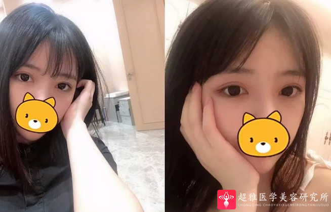 双眼皮手术