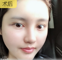 自体脂肪填充术
