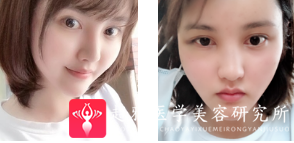 自体脂肪填充术