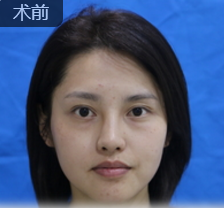 自体脂肪填充术