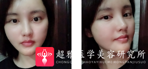 自体脂肪填充术