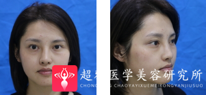 自体脂肪填充术