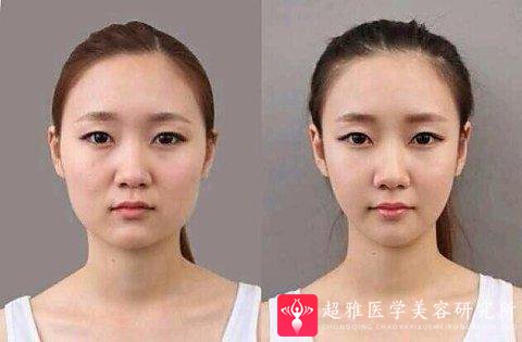 超声波瘦脸