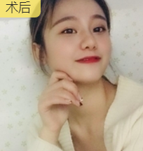 面部提升术