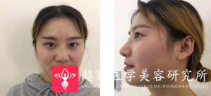 面部提升术