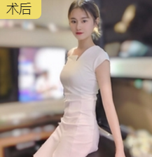 面部提升术