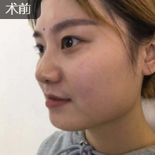面部提升术