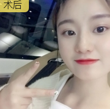 面部提升术