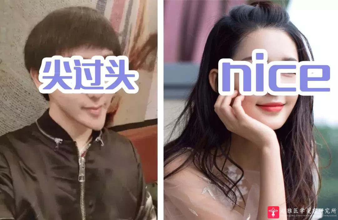 下巴延长术