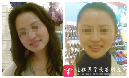 下巴延长术