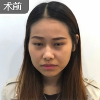 面部提升术