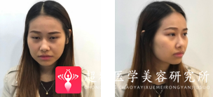 面部提升术