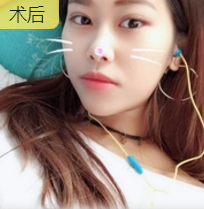 面部提升术