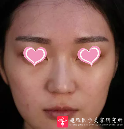 超声波瘦脸