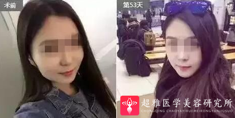 超声波瘦脸