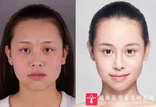 超声波瘦脸