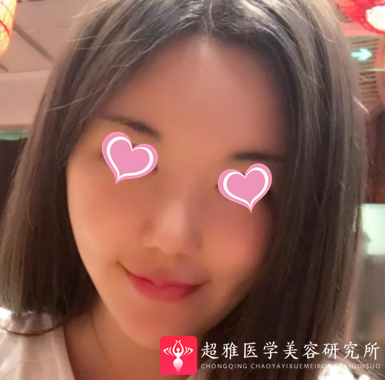 超声波瘦脸