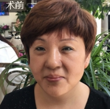 面部提升术