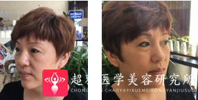 面部提升术