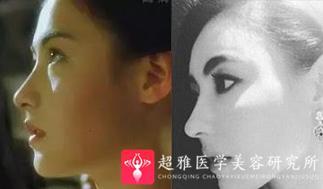 隆鼻手术