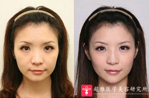 隆鼻手术