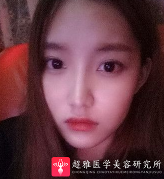 隆鼻手术