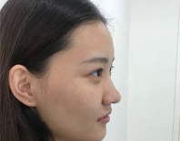 隆鼻手术