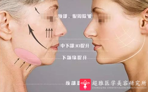面部提升术