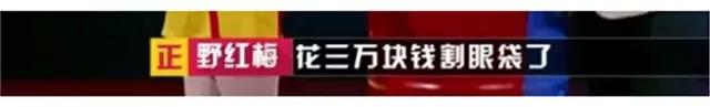 面部提升术