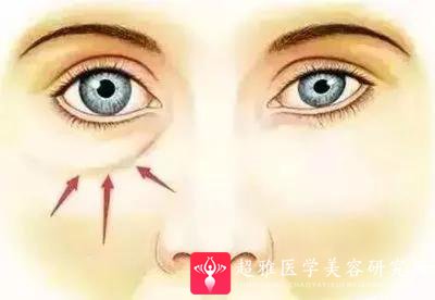 眼袋