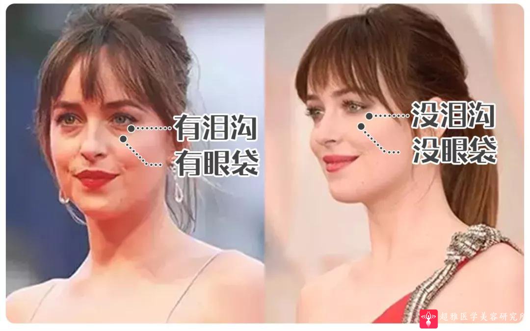 眼袋