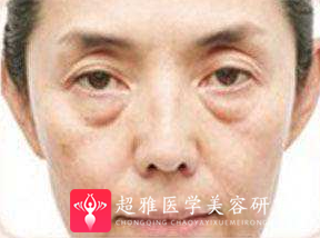 眼袋