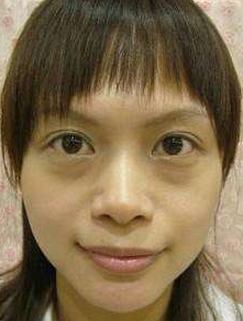 眼袋