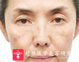 眼袋