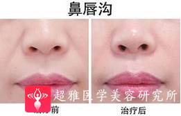 面部提升术