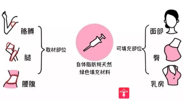 自体脂肪填充术