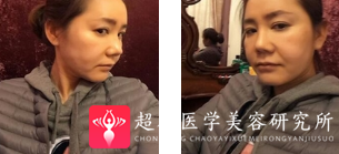 面部提升术