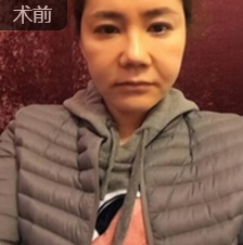 面部提升术