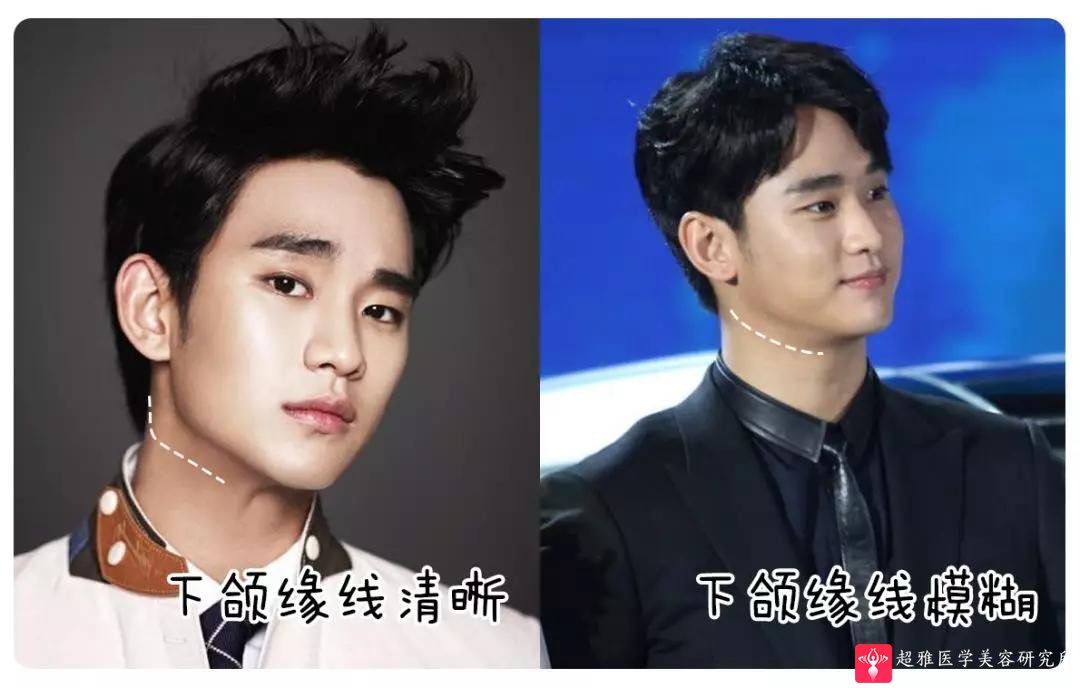 超声波瘦脸