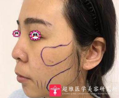 超声波瘦脸