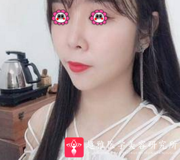 超声波瘦脸