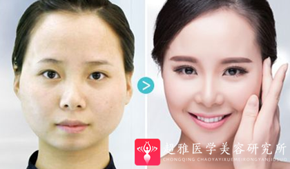 超声波瘦脸