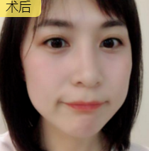 面部提升术
