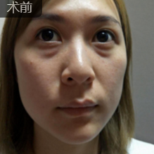 面部提升术