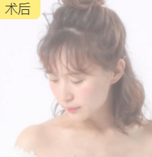 面部提升术